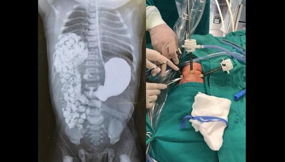 Al realizar una radiografía del bebé los especialistas se sorprendieron al ver que el intestino se había desplazado hacia el tórax y realizaba presión sobre sus pulmones. (Fotos: Minsa)