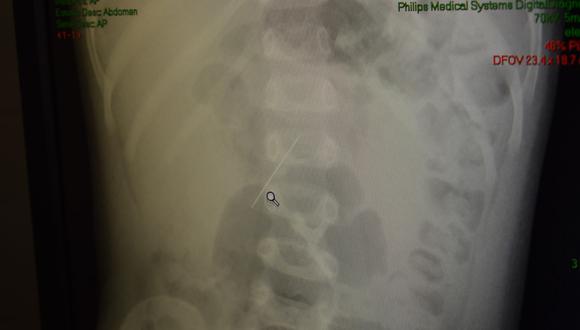 Un niño de dos años se tragó una aguja de coser que terminó incrustada en su intestino delgado. (Foto: INSN de Breña)