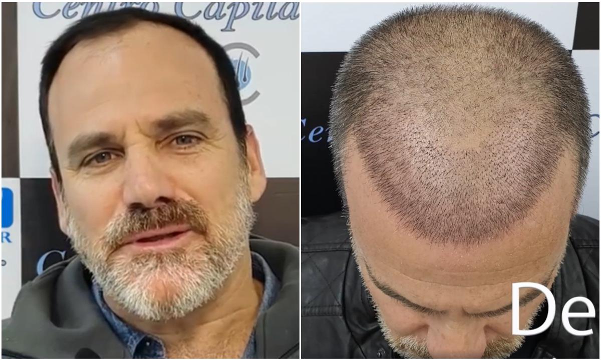 Omar Ruiz de Somocurcio protagonista de radical cambio físico tras implante capilar | VIDEO Facebook