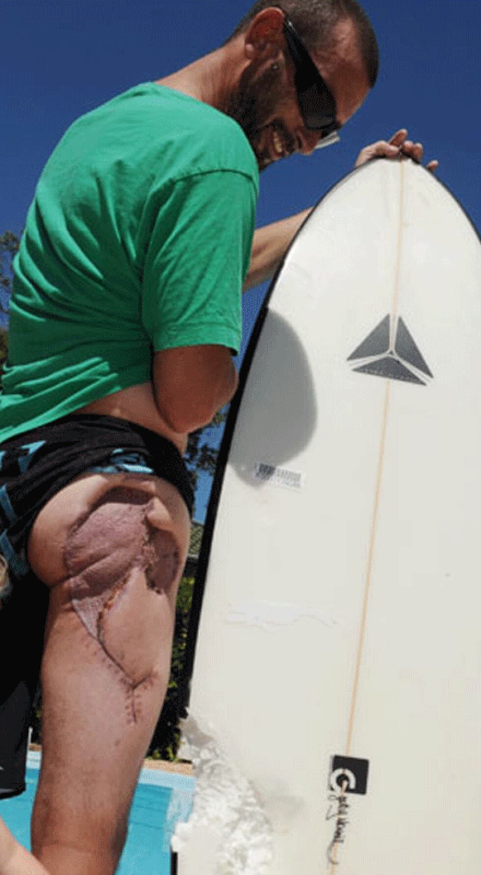 Glen Folkard pierde glúteo tras ser mordido por un tiburón