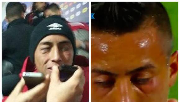 Copa América 2015: Así quedó el rostro Christian Cueva de tanto golpe venezolano