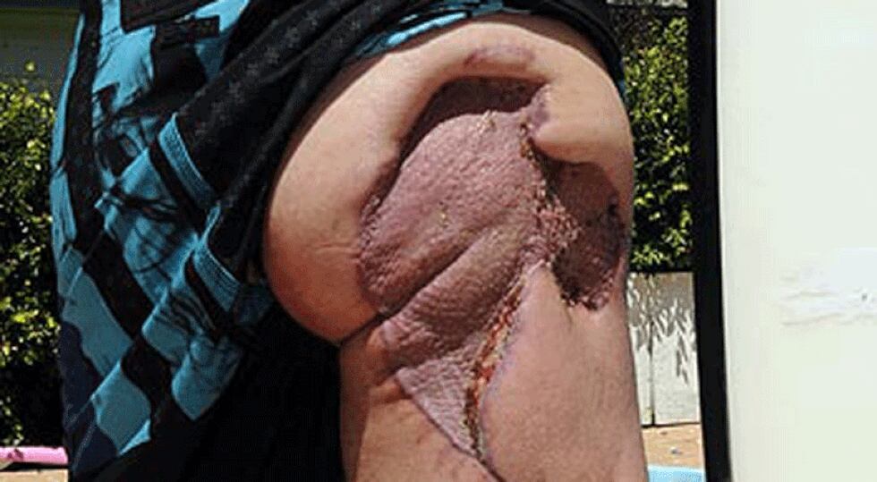 Glen Folkard pierde glúteo tras ser mordido por un tiburón