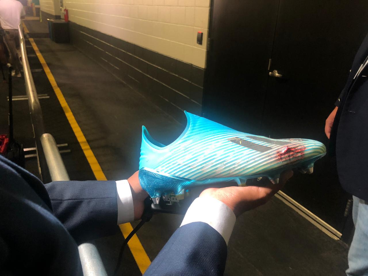 Perú vs. Colombia | Así terminó el chimpún de Anderson Santamaría tras el pisotón de Yerry Mina | FOTO