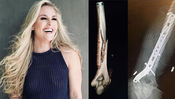 Esquiadora sufrió un terrible accidente y así quedó su brazo [FOTOS]