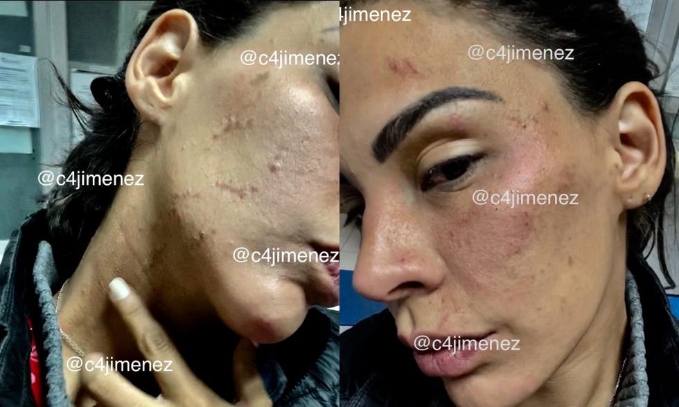 El periodista Carlos Jiménez publicó en su cuenta de twitter las fotografías de cómo quedó el rostro de Stephanie Valenzuela tras la denuncia de agresión contra Eleazar Gómez